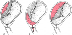 Types of Placental Abruption