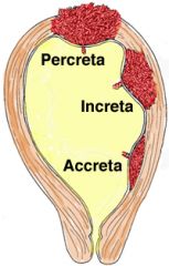 Types of Placenta Accreta