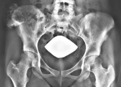 What do you do about this painful lesion in a 14 year old postmenarchal girl with prominence over her right hip. 