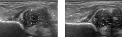 7 months old girl has the ultrasound of the right and left hip as shown. How do you treat?