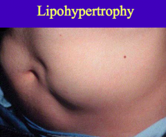 Lipohypertrophy:
- Occurs when insulin is injected repeatedly in the same small area
- It is a direct consequence of insulin's lipogenic action on the subcutaneous adipose tissue
*Can be avoided w/ site rotation