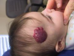 Infantile hemangioma 
- GLUT1 positive (stain used to confirm dx if in question)