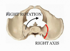 Right rotation because the sacral promontory is rotating to the right