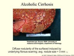 1. Complication and irreversible form of alcohol induced damage


2. Shrunken, firm liver with hobnail appearance