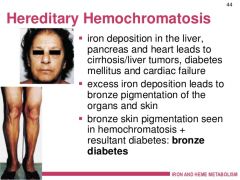 1. Hepatomegaly, abdominal pain, arrhythmias, arthritis 


2. Bronze diabetes: classic triad of cirrhosis w/ hepatomegaly, skin pigmentation, and diabetes mellitus
