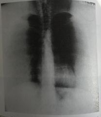 The radiograph shown in Figure 4-21 illustrates incorrect use of 