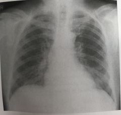 Figure 4-20 was made using screen-film technique. The area of blurriness seen in the upper part of the radiograph shown is most likely due to 