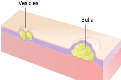 Vessicles and bulla both contain clear fluid.

Vessicle < 1cm
Bulla > 1 cm