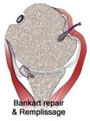 1-Sup labrum ant to pos (SLAP) repair; 2-Open approach for BG of hum defect w/allograft; 3-Open repair of (HAGL) lesion; 4-Remplissage proced; 5-Arthroscopic Bankart repair and Remplissage proced:::chronic Bankart tear & engaging Hill-Sachs -> ant...