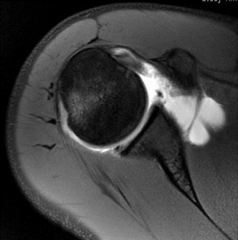 25yo basketball player s/p ant shoulder dislocation during a game that is subsequentlyC R w/ tx. MRI will most likely show which of the following? 1-supraspinatus tear; 2-HAGL; 3-Long head of the biceps tear; 4-Sup labrum ant to pos tear; 5-Antero...