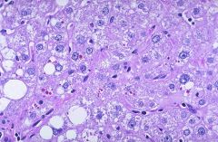1. Autosomal recessive disorder associated w/ emphysema 


2. PiZZ: Abnormal gene on Chromosome 14 


3. ATT retained in hepatocytes as cytoplasmic globules (stain PAS positive) 


4. Cirrhosis occurs in adulthood