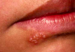 Case 1:
- 18 yo HS senior presents w/ 1 day of painful blisters around her mouth
- She had an eruption like this about a year ago in same location
- No PMH, allergies, or family hx
- Meds: ibuprofen as needed

How would you describe the skin...