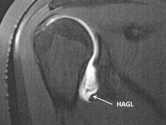 classic teaching is that HAGL lesions requires open repair of the capsule, whereas the other lesions listed are felt to be better addressed with an arthroscopic approach.Ans2