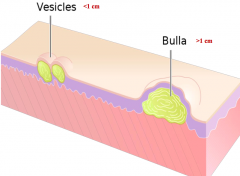 - Left: vesicles (<1 cm)
- Right: bulla (>1 cm)