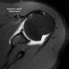 1- Anteroinferior labral nonunion; 2-Unrecognized (HAGL); 3-Anteroinferior glenoid bone defect; 4- Engaging Hill Sachs defect; 5-Untreated SLAP lesion:::MRI (+) anteroinferior glenoid fracture (bony Bankart). This was not addressed at initial surg...