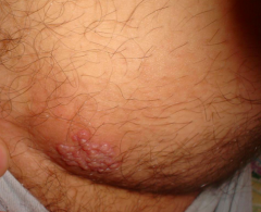 What kind of lesion is this?