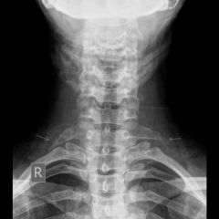 35yo businessman c/o tingling and numbness in his fingers of both hands, mostly in the ring and small fingers, made worse with overhead activity. Neurologic exam and electromyography-nerve conduction study is nl. His cervical spine x-ray is shown ...