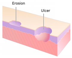 Erosions (only in epidermis) and Ulcers (extended into dermis)