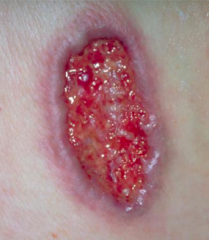 What kind of lesion is this?