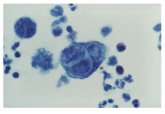 Positive Tzanck Smear

Merged with other cells. They are fusigenic. Becomes a large gigantic multinucleated cell.