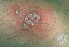 Herpes Simplex (clustered vesicles on erythematous base)