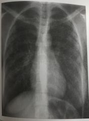 The PA chest image shown in Figure 4-13 exhibits which of the following qualities? 