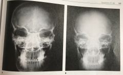 Two screen-film images of the skull are shown in Figure 4-10. Which of the following best describes their different appearance?