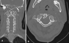 FigA CT 27yo M that suffered a fall from a significant height. Which of the following xray meas would best indicate disruption of the transverse lig? 1-(ADI) =3mm; 2-Pos atlanto-dens interval (PADI) = 16mm 
3-C2 pars horizontal displac=3 mm; 4- C...