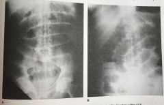 Which of the radiographs shown in Figure 4-5 most likely required the greater exposure?