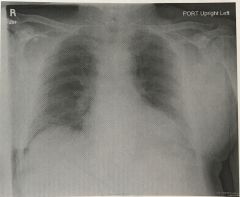 The chest radiograph shown in Figure 4-1 demonstrates 