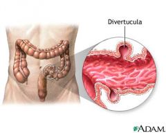 inflammation of the colonic diverticulum (a saclike mucosal outpouching through the colonic muscle)