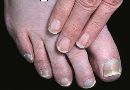 condition in which a somewhat bluish color is visible in the tonails and toes. This condition, especially when slight, may be hard to distinguish from normal skin color