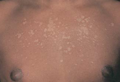 common superficial fungal infection of the skin, causing hypo- or hyper pigmented, slightly scaly macules on the trunk, neck, and upper arms. They are easier to see in darker skin and may be more obvious after tanning. In lighter skin, macules may...