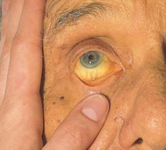 this condition makes the skin diffusely yellow. It is seen most reliably in the sclera. It may also be visible in mucous membranes. Causes include liver disease and hemolysis of red blood cells