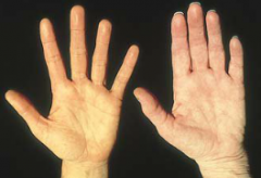 the yellowishness plam of carotenemia is compared with a normally pink palm. This condition does not affect the sclera, which remains white. The cause is a diet high in carrots and other yellow vegetables or fruits. It is not harmful but indicates...