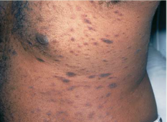 Reddish oval ringworm-like papules or plagues
