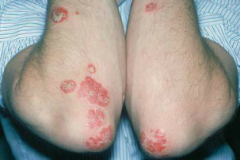 Silvery scaly papules or plagues, mainly on the extensor surfaces