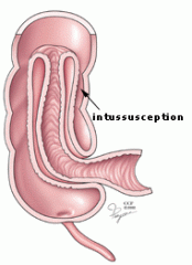 1, diverticulitis


2. volvulus - tangled intestine


3. itussusception - part of intestine slides back into another section of intestine


4. hernia
