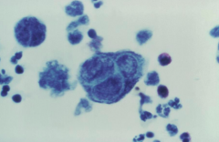 Positive Tzanck smear (multinucleated giant cells)