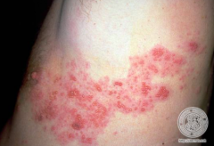 Mr. Berman has a dermatomal grouping of vesicles on an erythematous base, on his trunk. What is the most likely diagnosis?
a) Allergic contact dermatitis to poison ivy
b) Bullous fixed drug eruption
c) Dyshidrotic eczema
d) Herpes simplex type...