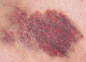Color & Size: Purple or purplish blue, fading to green, yellow, and brown with time. Variable in size, larger than petechiae, >3 mm
Shape: Rounded, oval, or irregular; may have a central subcutaneous flat nodule (a hematoma)
Pulsatility and Effect...