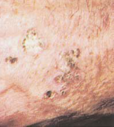 superficial, hyperkeratotic papules. Often multiple; can be round or irregular; pink, tan, or grayish. Appear on sun-exposed skin of older, fair-skinned people. Considered to be dysplastic or precancerous; one of every 1,000 per year develop into ...