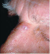 Though malignant, grows slowly and almost never metastasizes. It is common in fair-skinned adults 40 years or older, and usually appears on the face. An initial red macule or papule may develop a depressed center and a firm, elevated border. Telan...
