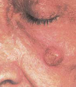 Usually appears on sun-exposed skin of fair-skinned adults older than 60 years. May develop in an actinic keratosis. Usually grows more quickly than a basal cell carcinoma, is firmer, and looks redder. The face and the dorsum of the hand are often...