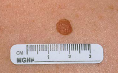 common mole. usually appears in the first few decades. Several nevi may arise at the same time, but their appearance usually remains unchanged.
Typical Features:
-round or oval shape
-sharply defined borders
-uniform color, especially skin-colored...