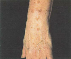 macules on the dorsum of the hand, wrist, and forearm