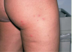 papules and pustules