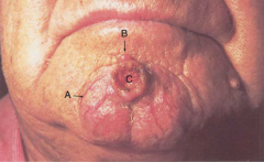 A) Telangiectasia
B) Nodule
C) Ulcer