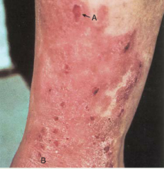 A) Excoriation
B) Lichenification on the leg