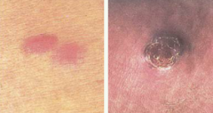 malignant tumor may appear in many forms: macules,papules, plaques, or nodules almost anywhere on the body. Lesions are often mulitiple and may involve internal structures.